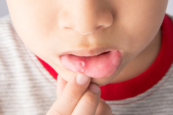 Bé 5 tuổi thường xuyên bị nhiệt miệng, làm cách nào chữa khỏi?
